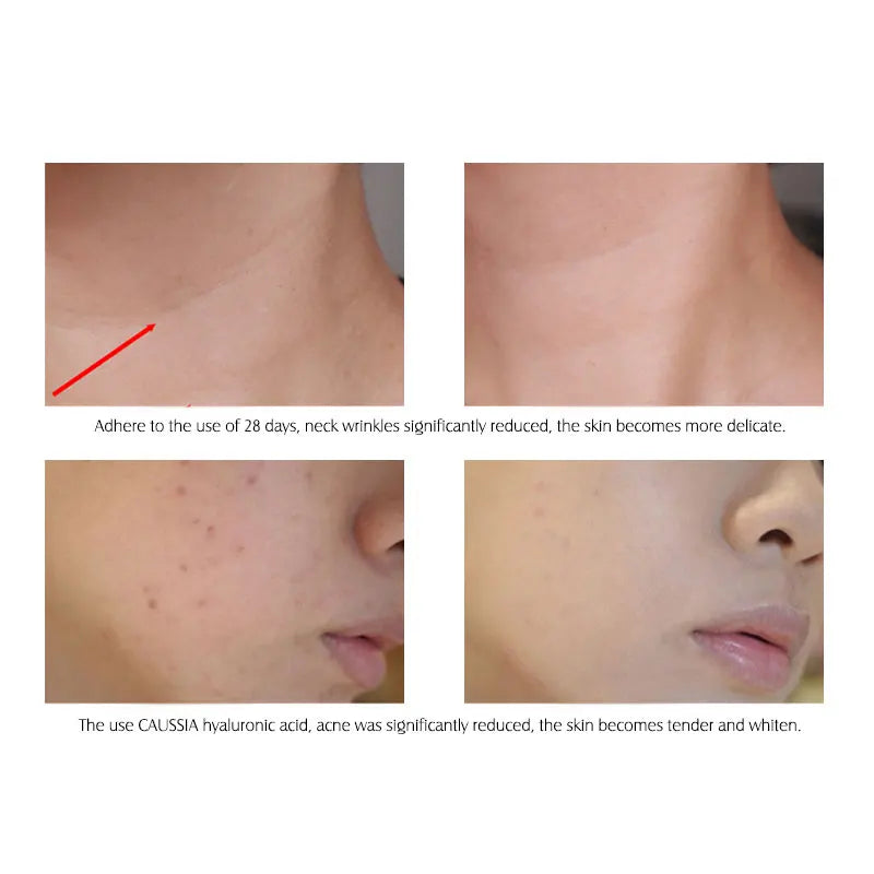ARTISCARE Hyaluronic Acid Face Serum 3pcs for Hydrating Moisturizer Liquid Essence Skin Care Cream