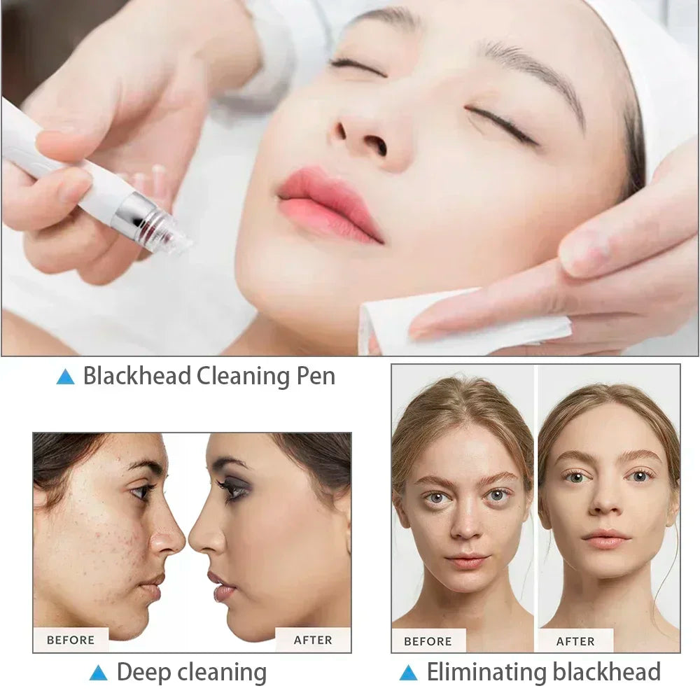 Skintierest 6in1 Multifunctional Water Coagulation Oxygen Micro Grinder H2o2 Professional Skincare and Cleansing Machine